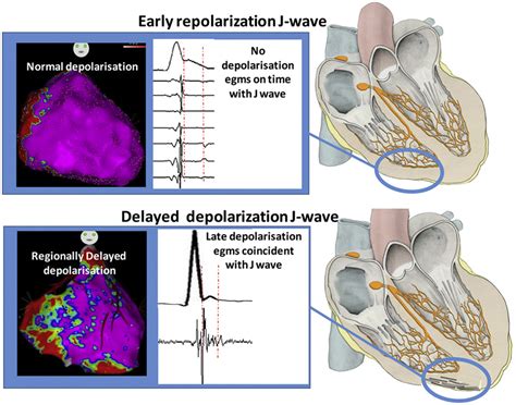 Depolarization Versus Repolarization Abnormality Underlying