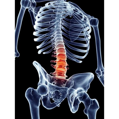 Symptoms of Lumbar and Thoracic Spine Fracture - Singapore Sports and ...