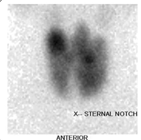 Tc 99 M Thyroid Scan Showed Diffusely Increased Uptake By The Thyroid