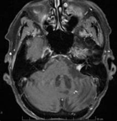 Neurinoma Del VIII Nervo Otorino Tanzariello