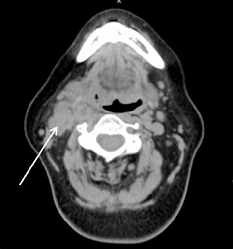 Ct Scan Enlarged Lymph Nodes Ct Scan Machine Images And Photos Finder