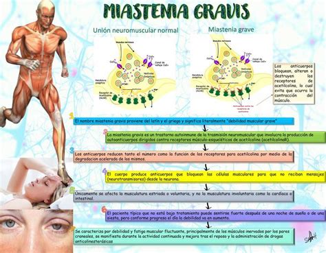 Fisiopatologia Da Miastenia Gravis BRAINCP