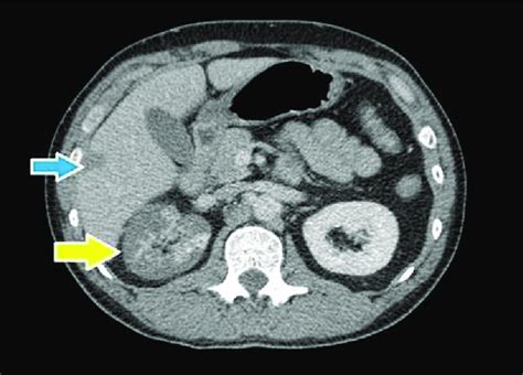 Contrast Enhanced Ct Images Axial Showing Involvement Of Right Renal Download Scientific