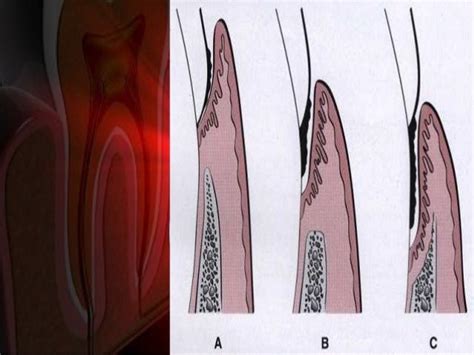 Periodontal pockets