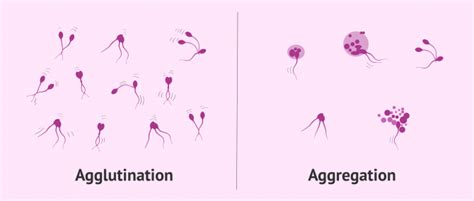 Difference Between Sperm Agglutination And Sperm Aggregation