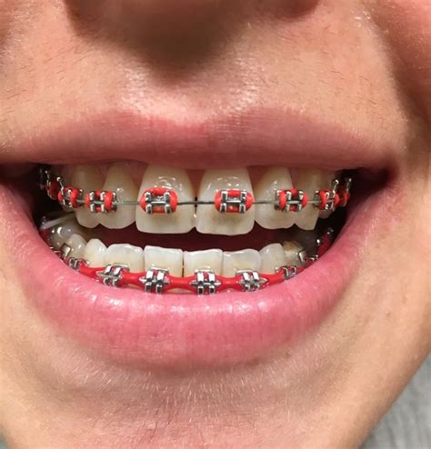 Pin By Gianellavv On Braces Braces Teeth Colors Teeth Braces Cute