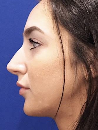 Nasal Hump Closed Rhinoplasty Mao Facial Plastics