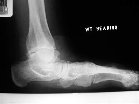 Total Ankle Arthroplasty Foot Ankle Orthobullets