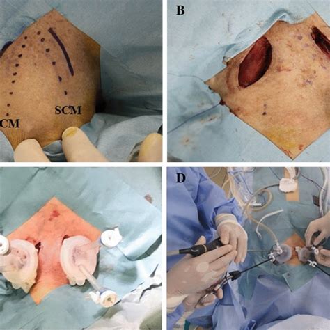 Bilateral Cervical Skin Incision And Port Placement For Bilateral