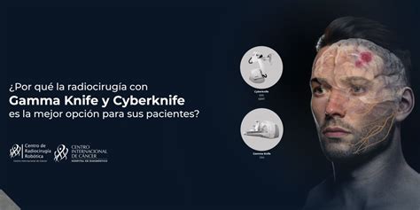 ¿por Qué La Radiocirugía Con Gamma Knife Y Cyberknife Es La Mejor