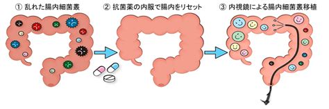 潰瘍性大腸炎を対象とした「抗菌薬併用腸内細菌叢移植療法」 ｜学校法人 順天堂のプレスリリース