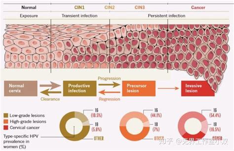 这可能是全网最深度的宫颈癌解读了强烈建议收藏 知乎
