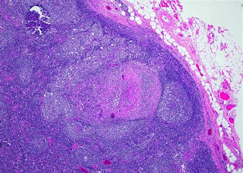 Lymphogranuloma Venereum Histology