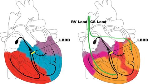 Cardiac Resynchronisation Therapy Current Indications Management And