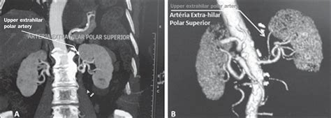 Scielo Brasil Multidetector Computed Tomography Angiography Of The