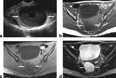 Variable Mr Findings In Ovarian Functional Hemorrhagic Cysts Kanso