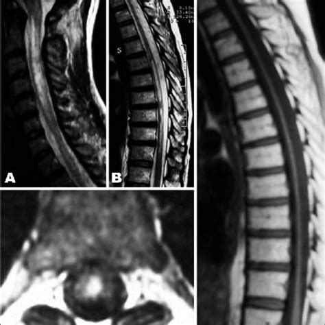 MRI Scans Of The Spinal Cord In Patients With Neuromyelitis Optica A