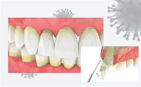 Periodoncia Enc As Bqdc