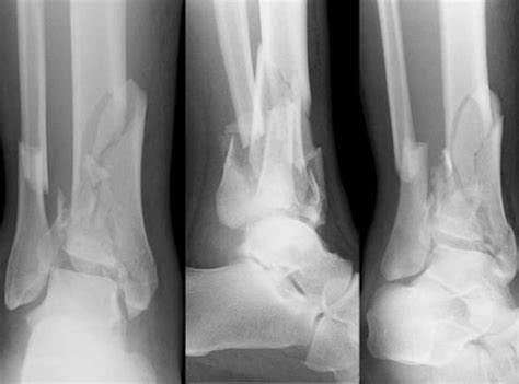 Distal Leg Fractures Wikem