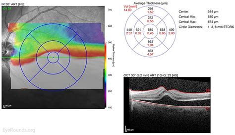 Rhegmatogenous Retinal Detachment The University Of Iowa Ophthalmology