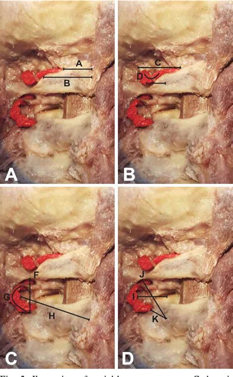 Figure 2 From Safety Ranges In V3 Segment Of The Vertebral Artery For Surgical Procedures At The