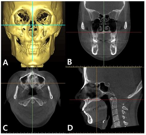 Sensors Free Full Text A Cbct Evaluation Of Midpalatal Bone Density