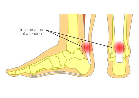 Achilles Tendonitis | Symptoms and Treatment | Caruso Foot and Ankle