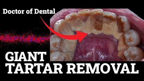 Giant Tartar Removal A Comprehensive Guide To Keeping Your Teeth Clean