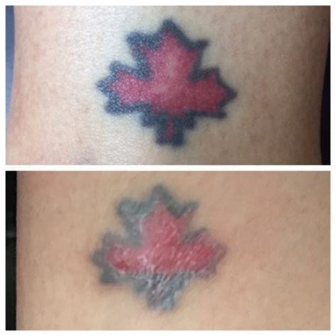 Saline Tattoo Removal Falcon Artistry Cosmetic Tattoos