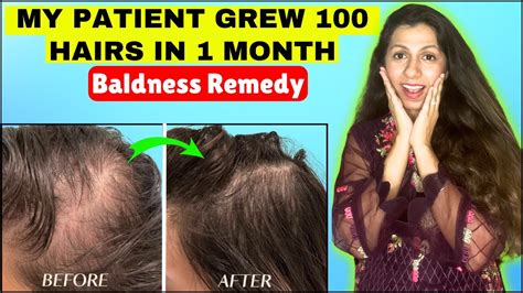 100 Best Hair Serum Doctor Recommended Best Hair Growth Serum At Home Extreme Hair Growth