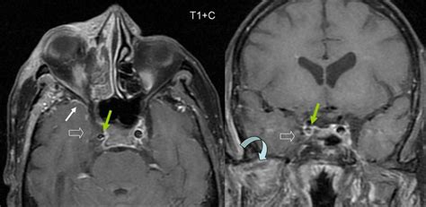 Cavernous Sinus Thrombosis Radrounds Radiology Network