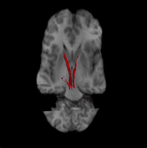 Nigrostriatal pathway - Wikiwand