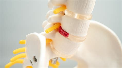 How To Treat Degenerative Disc Disease Ms Pain And Migraine