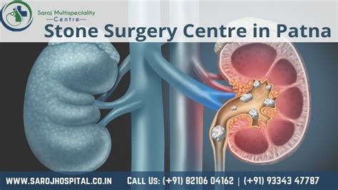 Best Stone Surgery Centre in Patna : Saroj Multispeciality Centre by ...