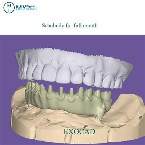 PEEK Titanium Intra Oral Dental Implant Scan Body To Take Digital