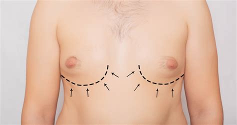 Causes Of Gynecomastia In Adolescents Dr Mordcai Blau