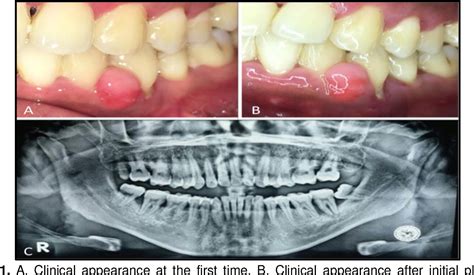 Figure 1 From Surgical Excision Of Fibrous Epulis In Generalized