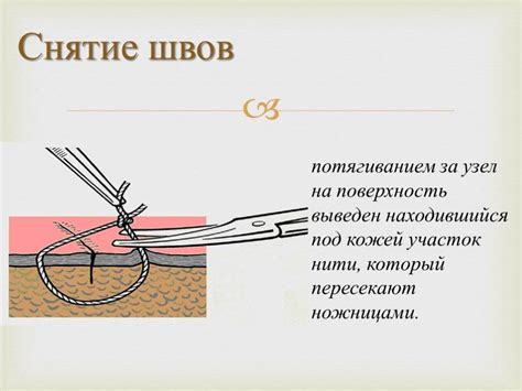 Как снять швы после операции