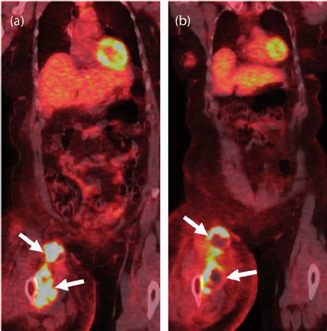 A 56 Year Old Woman With Pigmented Villonodular Synovitis Pvns