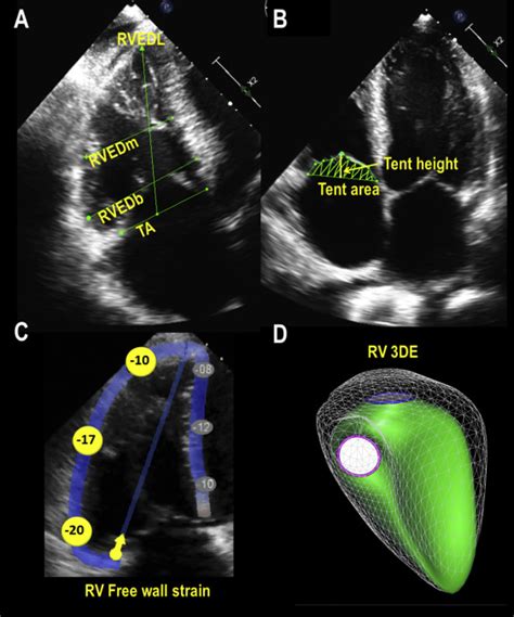 Refining Severe Tricuspid Regurgitation Definition By Echocardiography