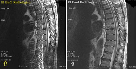 El Baúl Radiológico Artefacto De Anefacto Annefact Artifact In Mri