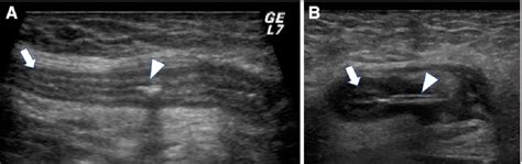 Ultrasound examination of right inguinal region. A: The appendix... | Download Scientific Diagram