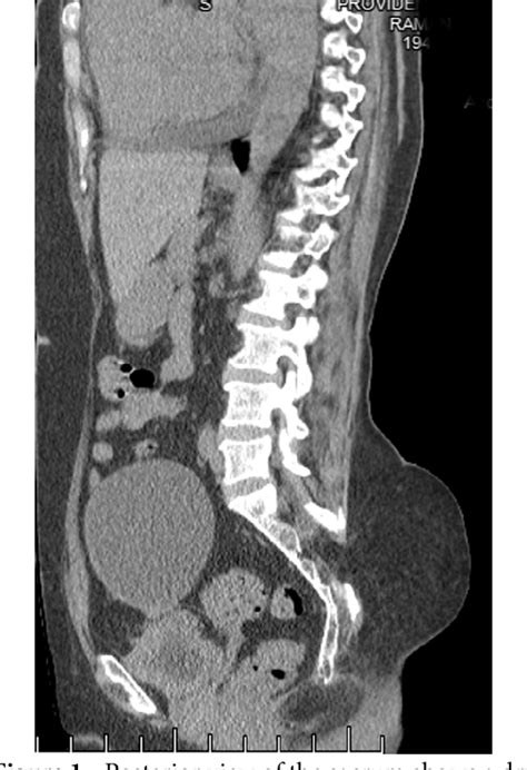 Figure 1 From Asymptomatic Spina Bifida Occulta Involving Sacrum In An