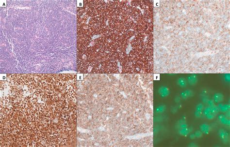 Fip1l1pdgfra Fusion Driving Three Synchronous Haematological