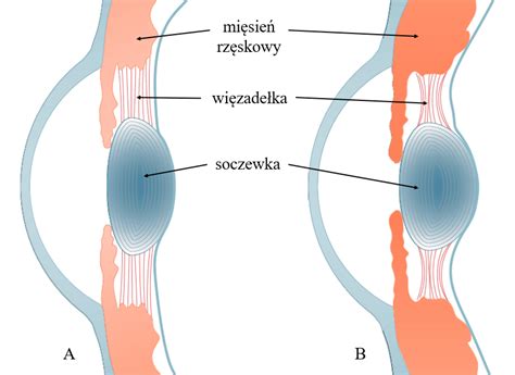 Czym Jest Akomodacja Platforma Edukacyjna Dla Pacjenta I Lekarza