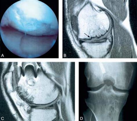 Medial Femoral Condyle Lesion