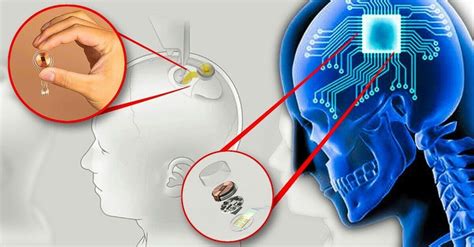 Neuralink empresa de Elon Musk dará início nos testes de chips