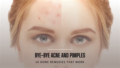 Top 4 Effective Home Remedies For Acne And Pimples