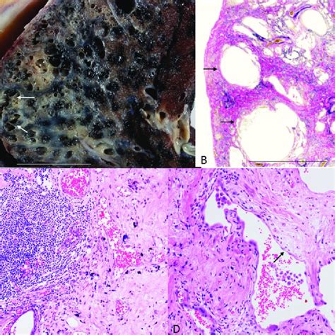 Pdf Asbestos Exposure Results In Asbestosis And Usual Interstitial