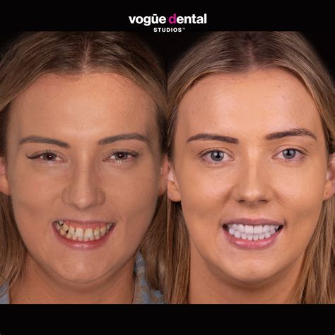 Picasso Porcelain Veneers Before And After Rebekah L Vogue Dental